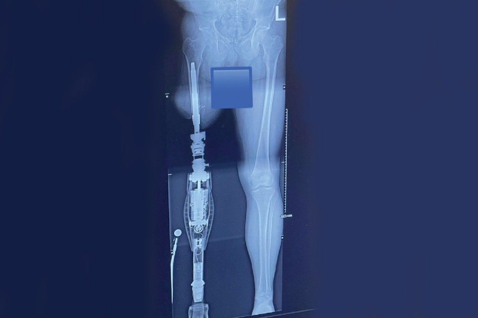 Osseointegration - A New Connection